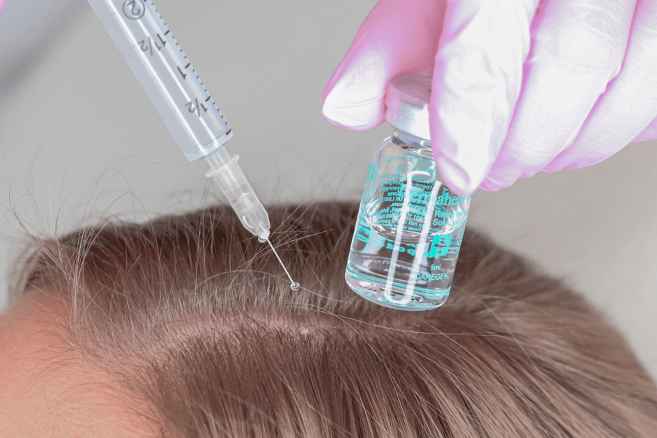 Mezoterapia – vlasová